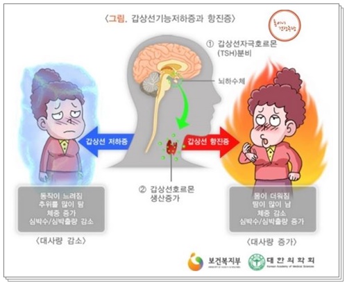 갑상선기능저하증003