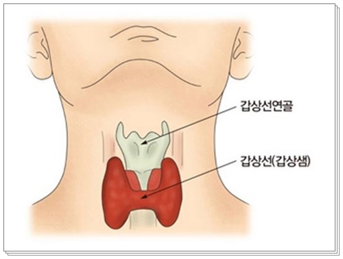 갑상선기능저하증004
