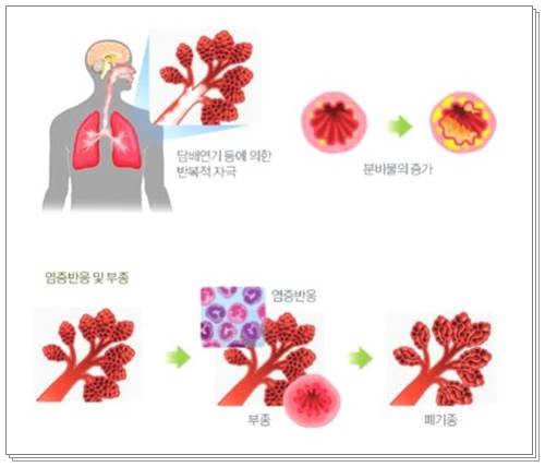 만성기관지염 증상005