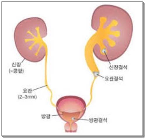 요로결석증상 원인 치료003