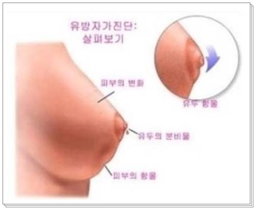 유방암 초기증상 원인002