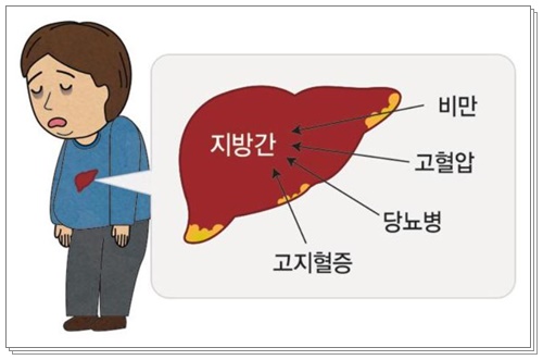지방간에 안좋은012